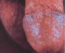 龜頭炎疾病因素與非疾病因素各有哪些?