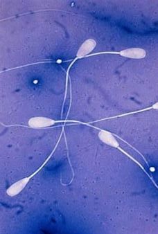 造成男性弱精癥的主要原因有哪些呢