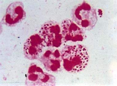 生殖器皰疹具有哪些主要傳染方式