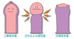 男性包莖會導致什么危害呢？