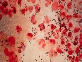 無緣無故就患有淋病，到底是咋回事?