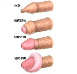 男性包皮過長的主要癥狀有哪些?