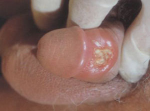 得了晚期梅毒還有機會治好嗎?