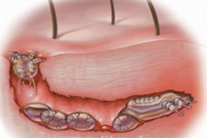 非淋菌性尿道炎應(yīng)該做什么檢查?