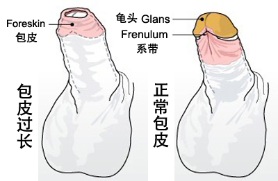 哪些癥狀表明男性有包皮過長現象?