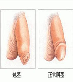 導致包莖的原因有哪些?