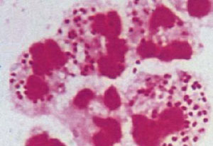 引發梅毒的原因有哪些?