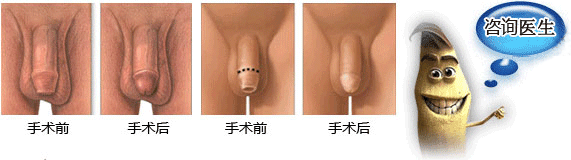 哪些是包皮過長埋下的隱患？