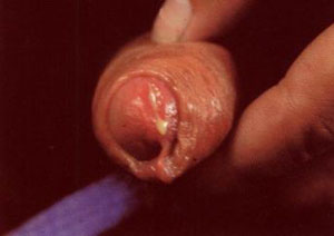 得了淋病該做哪些檢查呢